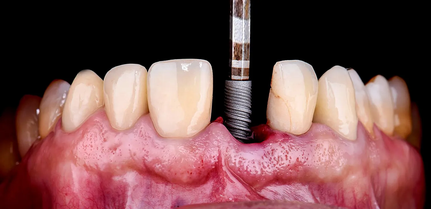 Endodoncja Szczecin post thumbnail image