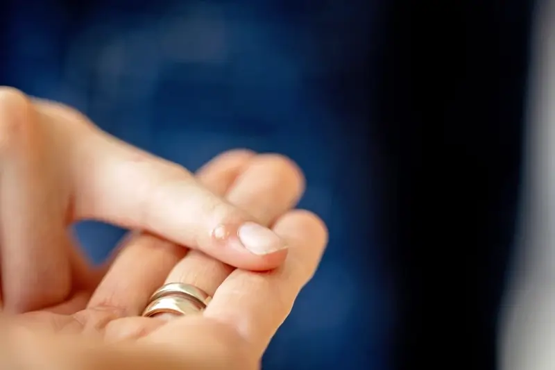 Kurzajki skąd się biorą?